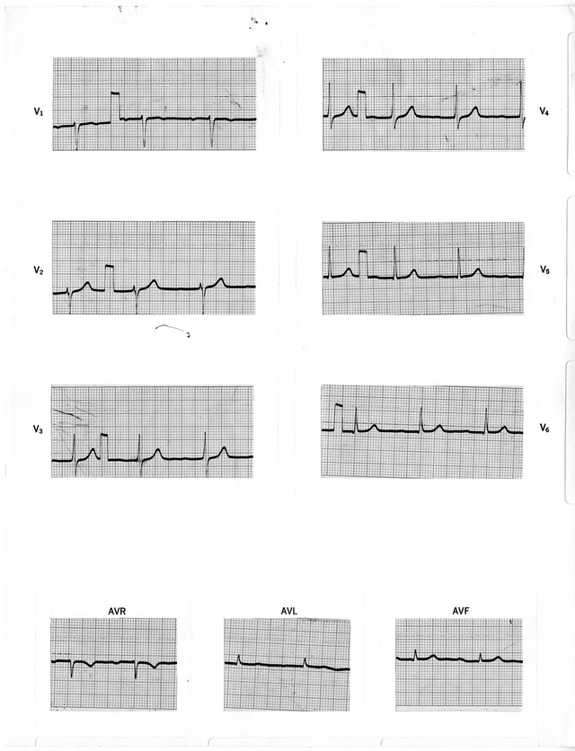 Electrocardiographic Report for Former President Harry S. Truman