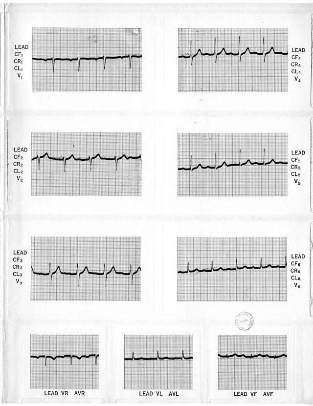 Electrocardiographic Report for Former President Harry S. Truman